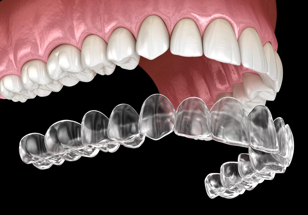 Dental Aligners: The Invisible Way to Improve Your Smile