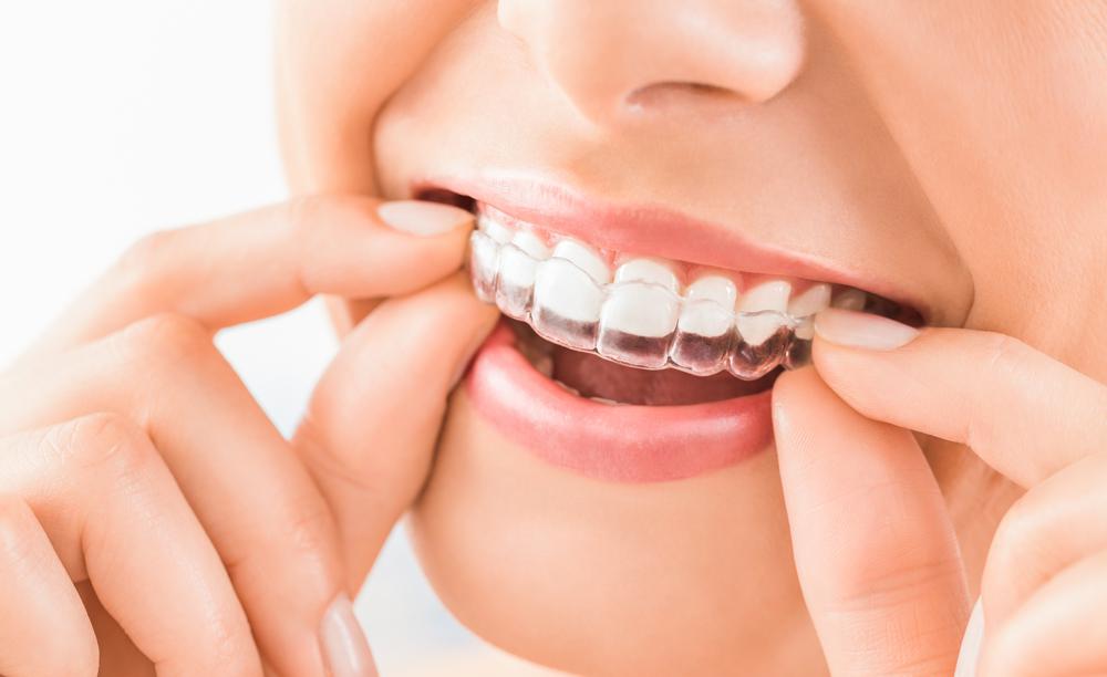 Dental Aligners: The Invisible Way to Improve Your Smile
