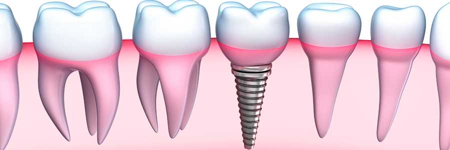 Dental Implants Specialty Astoria Queens