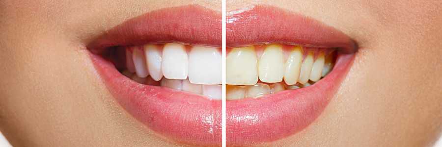 Teeth before whitening and after